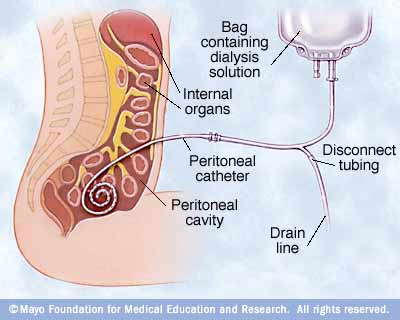 Peritoneal dialysis uses the lining of your abdominal cavity, 